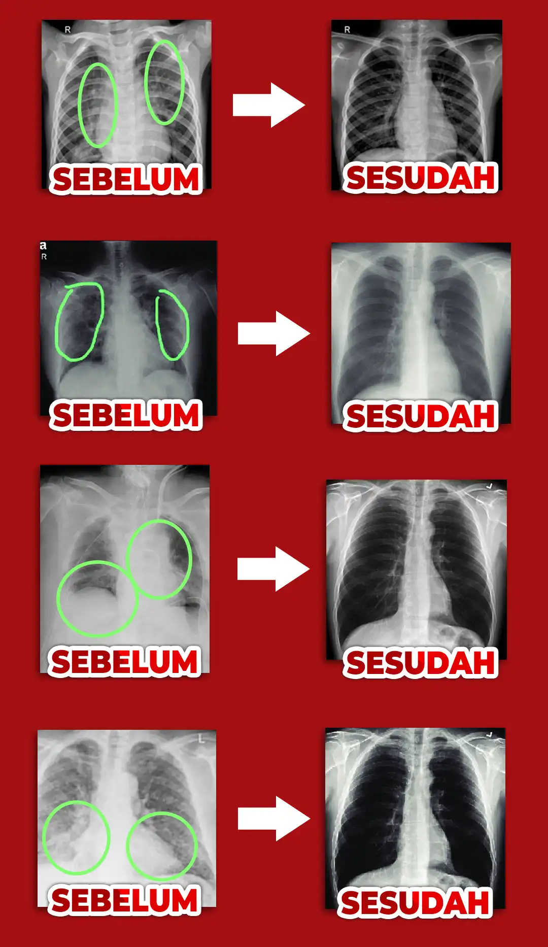 rontgen sebelum sesudah